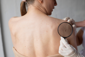 Melanoma Explained: Understanding Risk Factors and Prevention Techniques