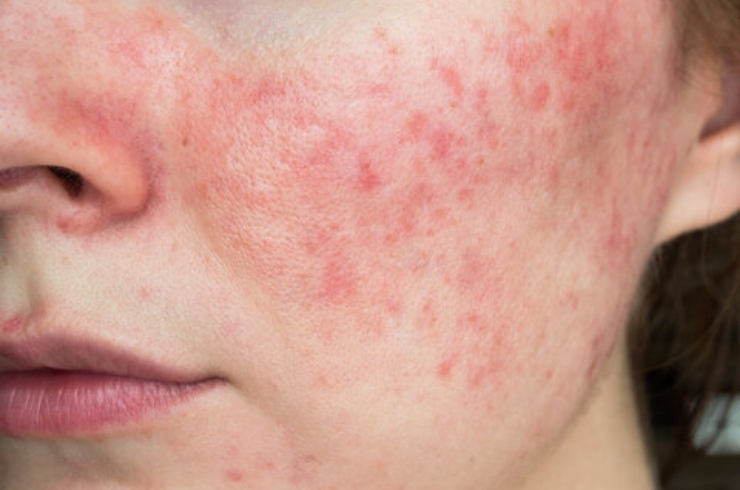Acne and Acne Scar Treatments