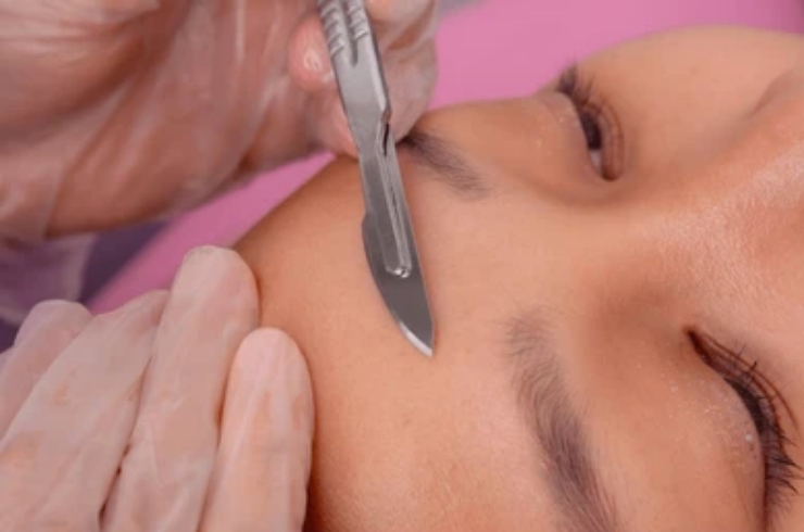Dermaplaning