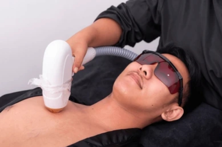 Laser Hair Removal