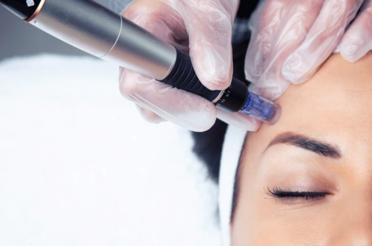 Microneedling