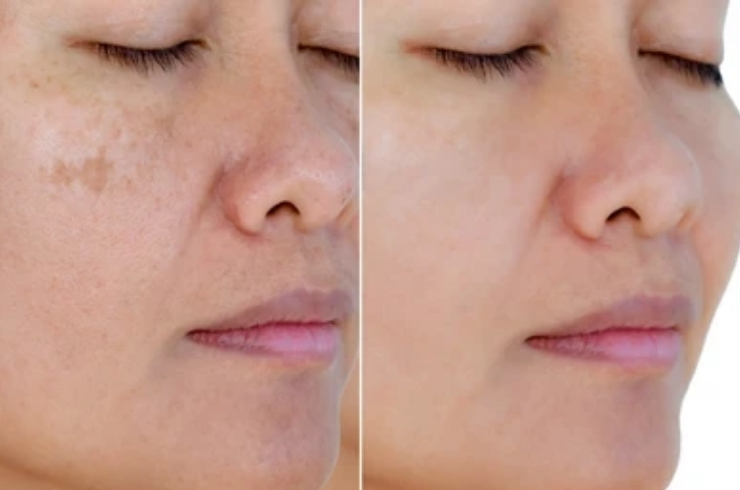 Pigmentation and Skin Lightening Treatments