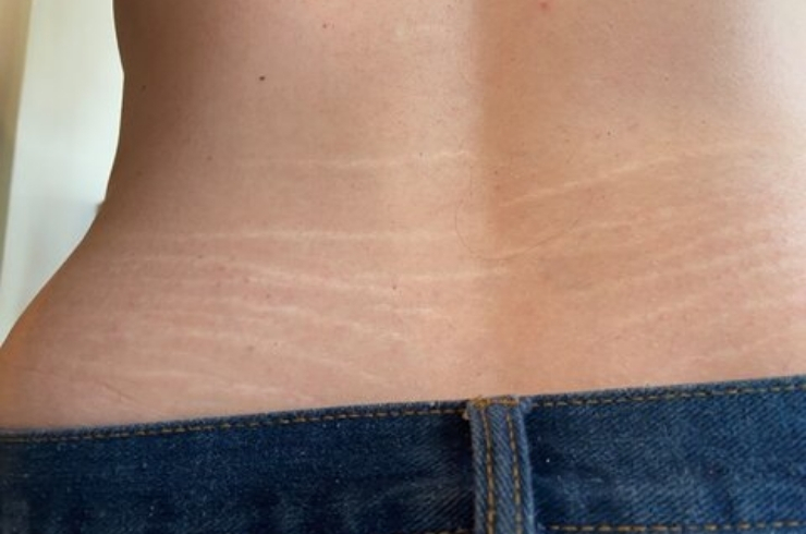 Stretch Mark Removal