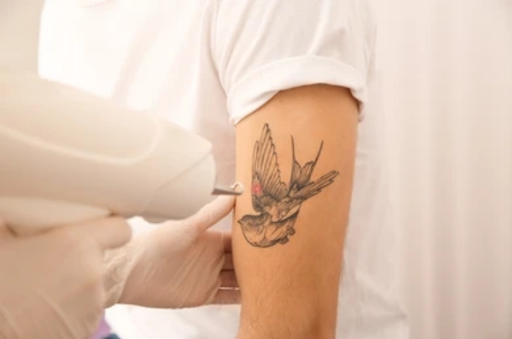 Tattoo Removal